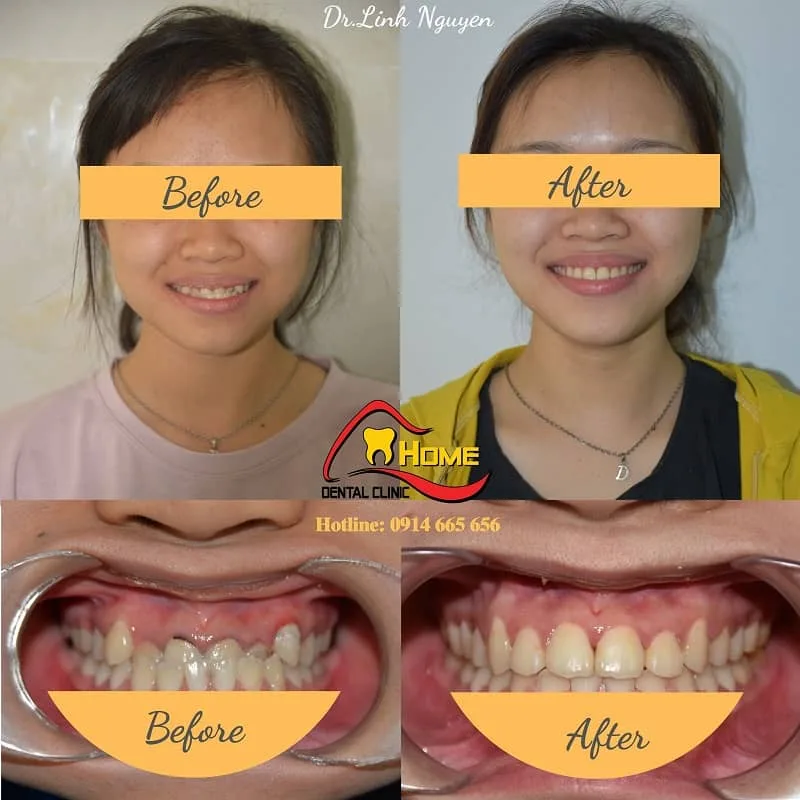 Niềng răng cho trẻ 10 tuổi giá bao nhiêu?