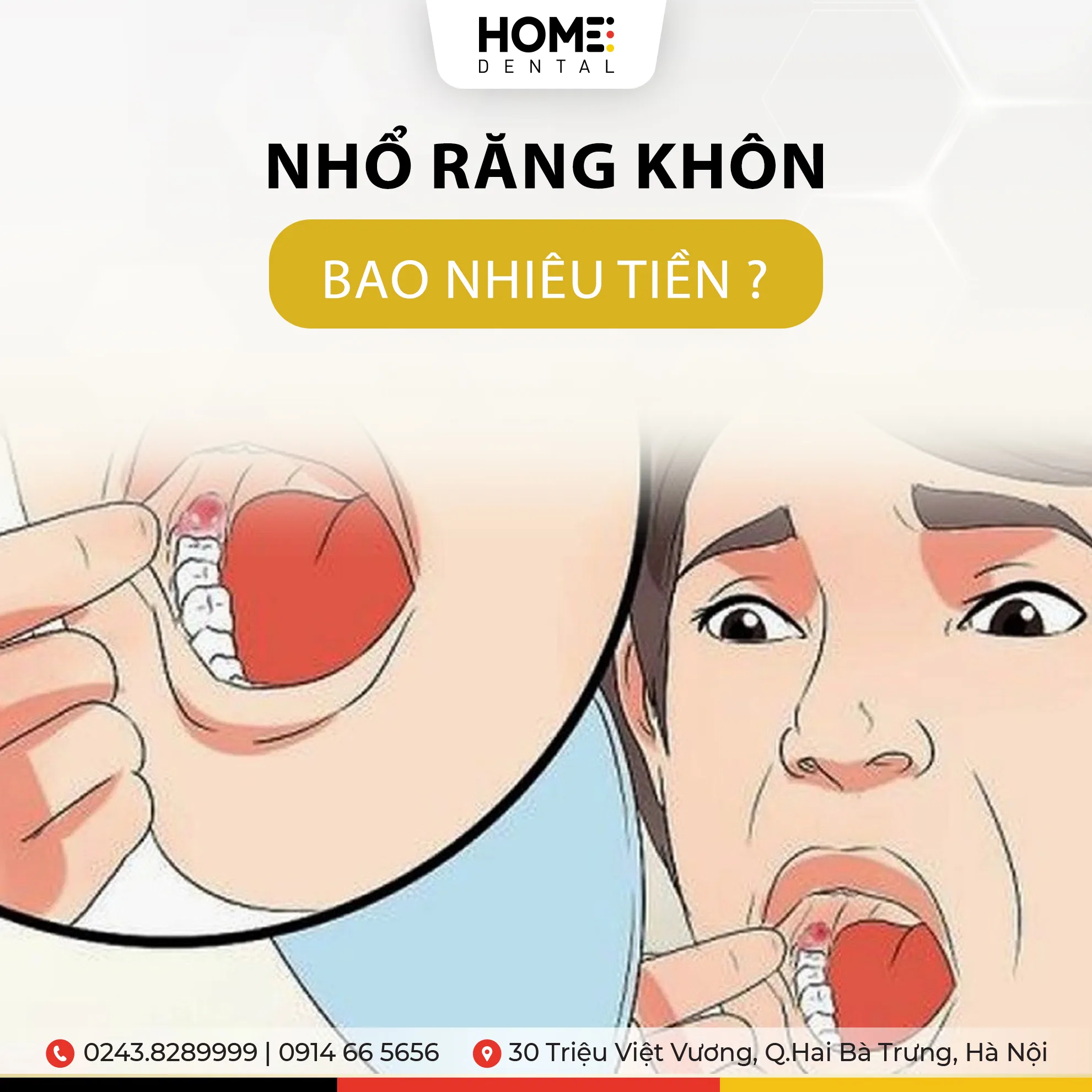 Chi phí nhổ răng khôn là bao nhiêu tiền?