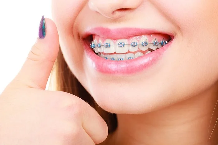 40 tuổi có niềng răng được không? Có Phù Hợp và Hiệu Quả Không?