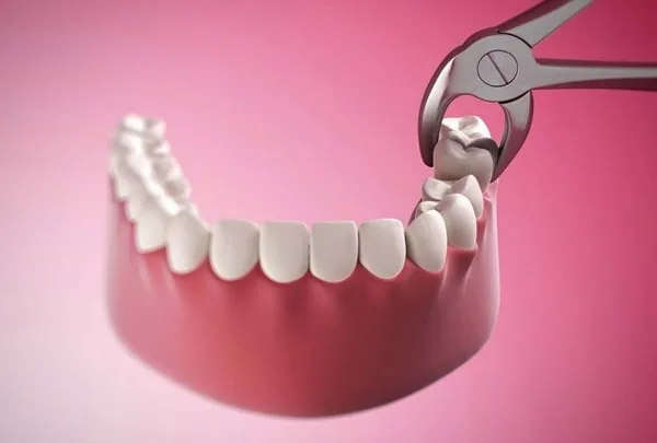 Nhổ răng khôn có bị tiêu xương không?