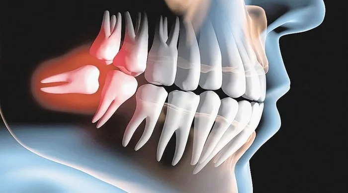 Nhổ răng khôn nằm ngang có nguy hiểm không?