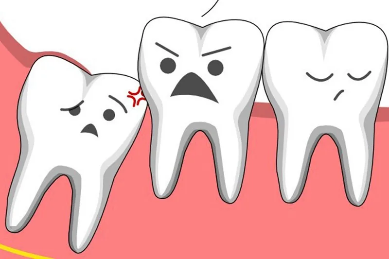 Niềng răng có cần phải nhổ răng khôn không?