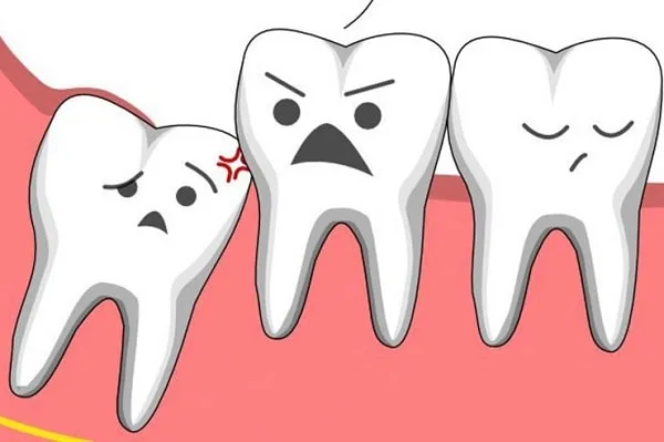 Có phải ai cũng mọc răng khôn?