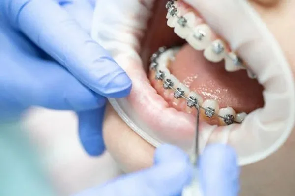 25 tuổi có niềng răng được không?