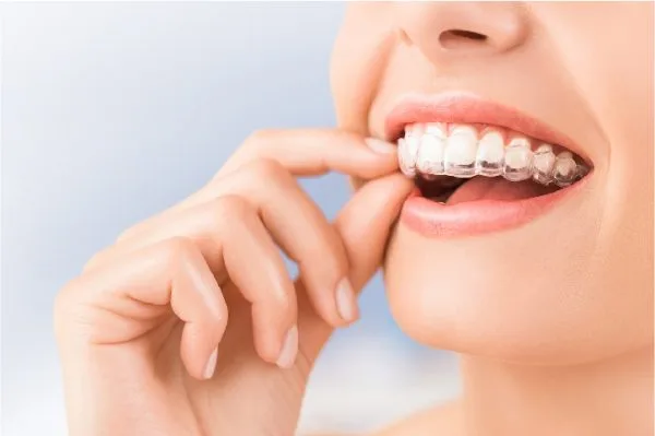 Phương pháp niềng răng tốt nhất hiện nay