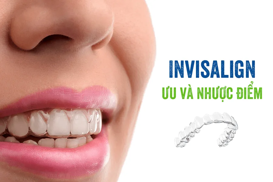 Niềng răng trong suốt invisalign - ưu và nhược điểm cần biết