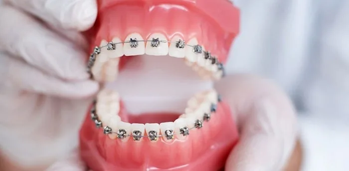 Viêm lợi có niềng răng được không?