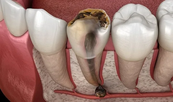 Triệu chứng sau khi lấy tủy răng và những lưu ý quan trọng