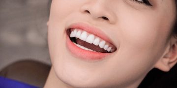 Bọc răng sứ cho 4 răng cửa bị hô có được không?