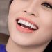 Bọc răng sứ cho 4 răng cửa bị hô có được không? 4 Bọc răng sứ cho 4 răng cửa bị hô có được không?