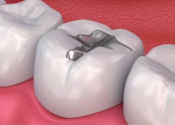 Sâu răng nhẹ đánh răng có hết không?