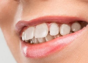 Bị hô hàm trên có niềng răng được không?