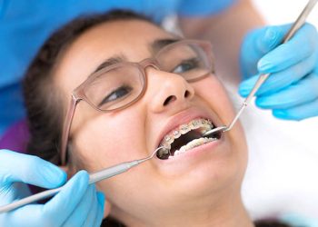 Trẻ 14 tuổi niềng răng bao lâu? Giá bao nhiêu?