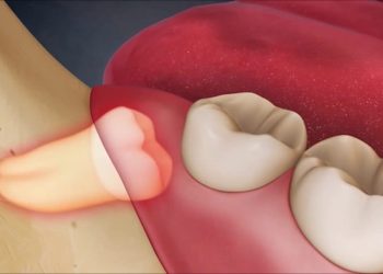 Răng khôn mọc lệch ra má có nên nhổ không?