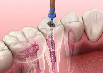 Lấy tủy răng xong bị sưng