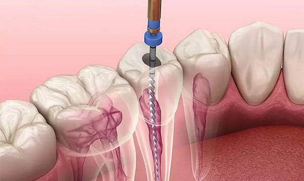 Lấy tủy răng xong bị sưng