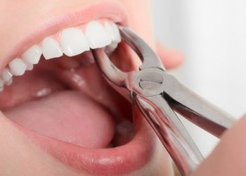 Nhổ răng cửa hàm trên có nguy hiểm không?