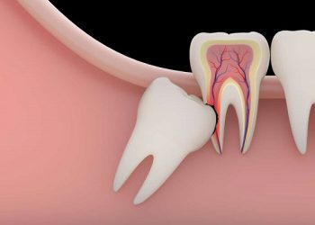 Chi phí nhổ răng khôn có được hưởng bảo hiểm y tế không?