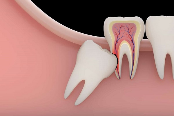 Chi phí nhổ răng khôn có được hưởng bảo hiểm y tế không?