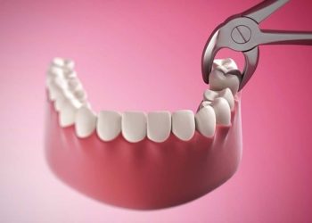 Nhổ răng khôn có bị tiêu xương không?