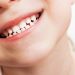 Trẻ 12 tuổi còn thay răng không? 5 Trẻ 12 tuổi còn thay răng không?
