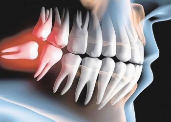 nhổ răng khôn nằm ngang có nguy hiểm không