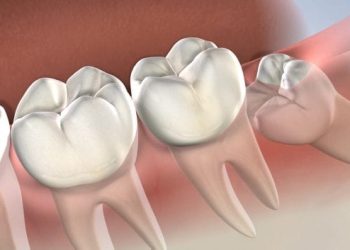 Sau khi nhổ răng khôn bao lâu thì được ăn cơm