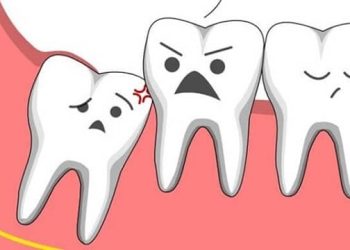 Răng khôn mọc lệch nhưng không đau có nên nhổ không?