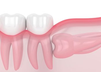Răng khôn mọc lệch 90 độ có nên nhổ không? giá bao nhiêu?