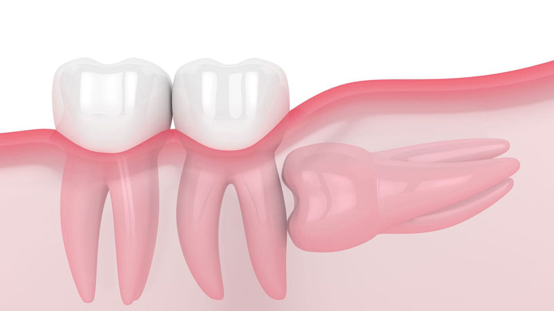 Răng khôn mọc lệch 90 độ có nên nhổ không? giá bao nhiêu?