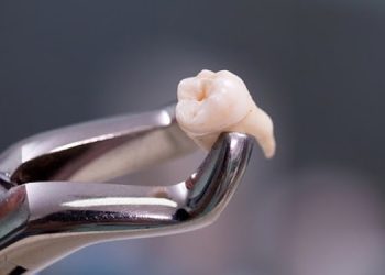 Vì sao nhổ răng khôn 1 tháng vẫn đau?