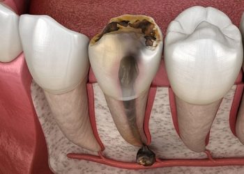 Triệu chứng sau khi lấy tủy răng