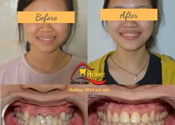 Giá niềng răng cho trẻ 10 tuổi