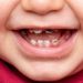 Bé 1 tuổi bị sâu răng phải làm sao? 7 Bé 1 tuổi bị sâu răng phải làm sao?