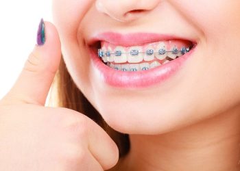 40 tuổi có niềng răng được không?