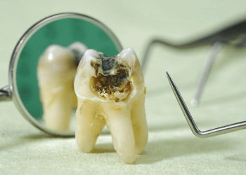 Răng khôn bị sâu có trám được không hay nên nhổ?