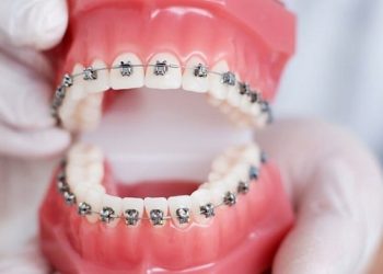 Viêm lợi có niềng răng được không?