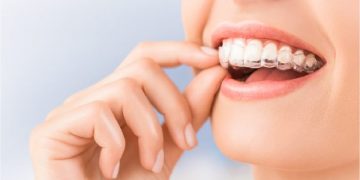 Niềng răng trong suốt Invisalign là gì?