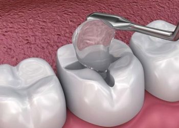 Răng khôn bị sâu có trám được không? Nên nhổ hay trám?