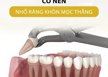 Nhổ răng khôn mọc thẳng có nên không?