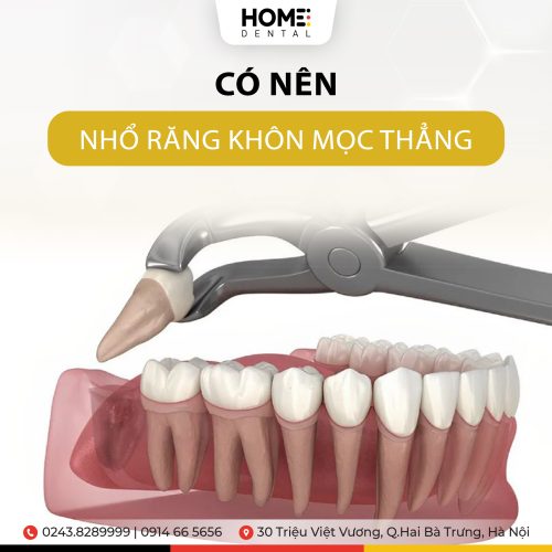 Nhổ răng khôn mọc thẳng có nên không?