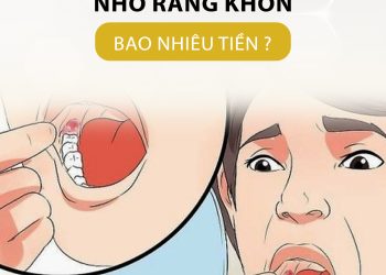 Chi phí nhổ răng khôn là bao nhiêu tiền?