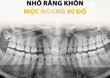 Răng Khôn Mọc Ngang: Cách nhận biết và những lưu ý