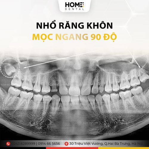 Nhổ răng khôn mọc ngang 90 độ