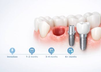 Nhổ răng số 5 bao lâu thì trồng lại được? Mốc chuẩn theo từng trường hợp