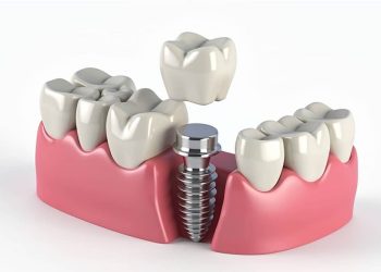 Trồng Implant Răng Cửa Giá Bao Nhiêu? Bảng Giá & Tư Vấn Chi Tiết