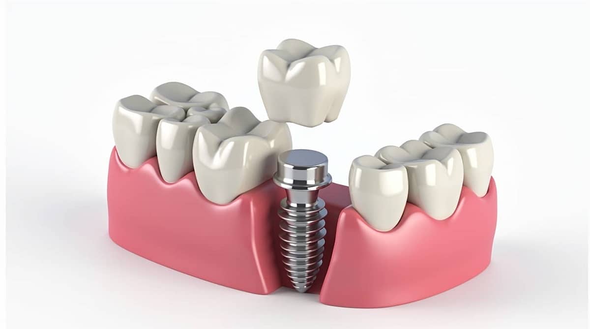 Trồng Implant Răng Cửa Giá Bao Nhiêu? Bảng Giá & Tư Vấn Chi Tiết