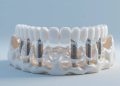 Cấy Ghép Implant All-On-6: Giải Pháp Phục Hình Răng Toàn Hàm Bền Vững 16 Cấy Ghép Implant All-On-6: Giải Pháp Phục Hình Răng Toàn Hàm Bền Vững