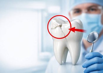 Răng Số 5 Bị Vỡ: Nguyên Nhân, Hậu Quả & Cách Chữa Nhanh