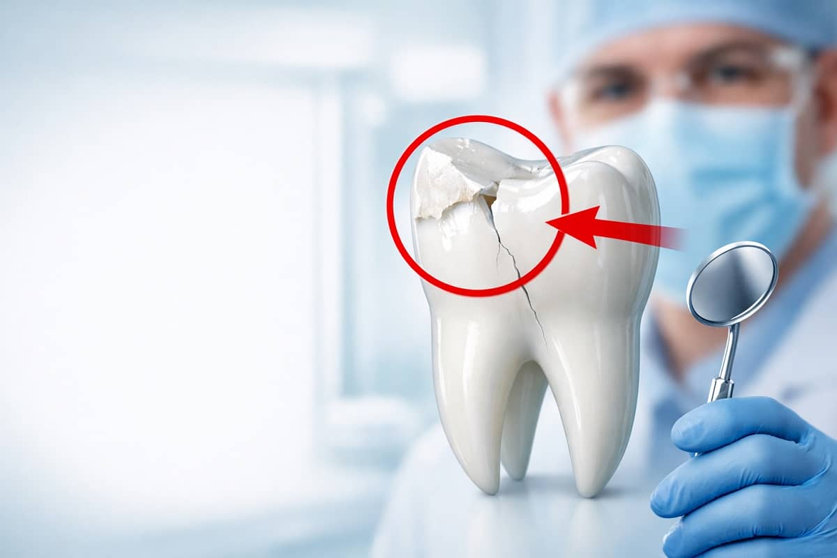 Răng Số 5 Bị Vỡ: Nguyên Nhân, Hậu Quả & Cách Chữa Nhanh